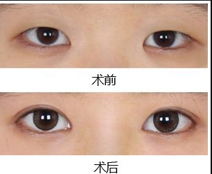 鄭州去黑點(diǎn)哪家醫(yī)院好？揭秘最受歡迎的黑點(diǎn)去除醫(yī)院