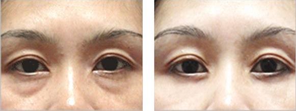 西安治療紅血絲哪家醫(yī)院查找費用明細最全？