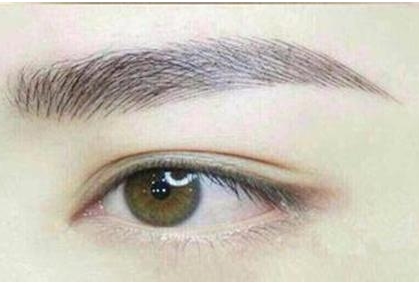 南京劉育鳳雙眼皮修復(fù)案例解析，效果如何？