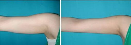 青島華諾整形：陳世俊的微整形經(jīng)驗分享