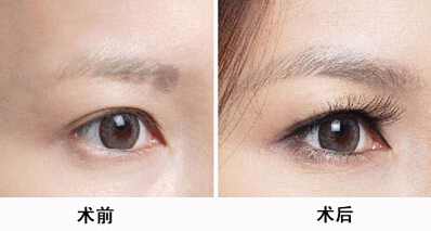 韓國(guó)醫(yī)生張柱允的顴骨磨骨技術(shù)整容潮流。