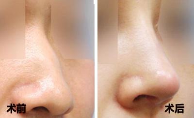 2023南京隆鼻失敗修復整形前十名醫(yī)生(李子海、黃聰、汪書平技術獨特，效果驚艷眾人)