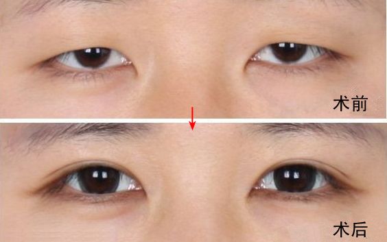 南京哪家醫(yī)院去眼袋好？眼袋手術(shù)選哪家醫(yī)院最好