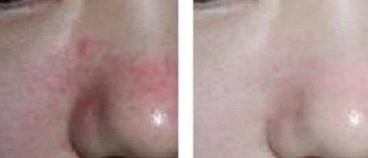 肇慶哪家醫(yī)院激光痣好？最受用戶歡迎的激光痣治療機(jī)構(gòu)有哪些？