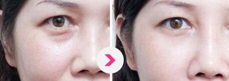 上海知名眼部整形專家出爐！2023年度指定眼王整形專家名單公布，附價(jià)格表參考！