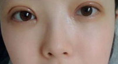 上海哪家醫(yī)院的雙眼皮手術(shù)效果最好？