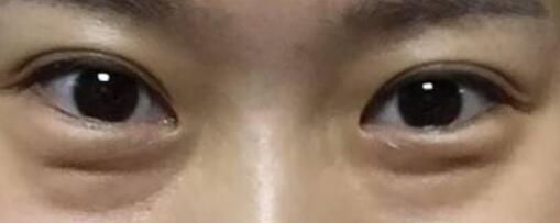 武漢鄭舉衛(wèi)在伊美馨醫(yī)院執(zhí)行乳房縮小手術(shù)效果如何？