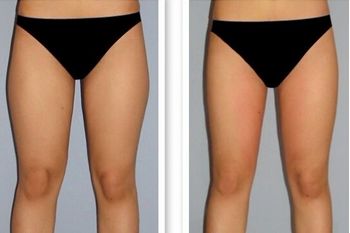 南昌哪家全科醫(yī)院有最好的外切眼袋手術(shù)效果？