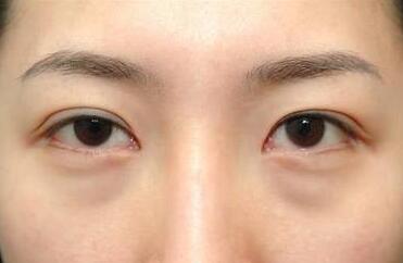 杭州面部提升醫(yī)生和專業(yè)醫(yī)院介紹，了解小拉皮技術(shù)好的醫(yī)生