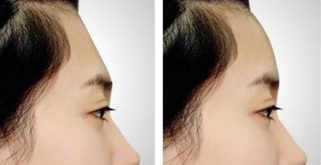 南京割雙眼皮哪家醫(yī)院效果好？