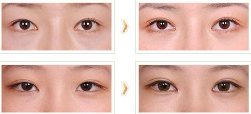 2023煙臺外眼角懸吊術(shù)前十專家排行(李岳令、張洪達(dá)、張鵬前十詳細(xì)點(diǎn)評)