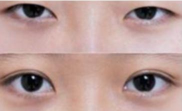 秦皇島雙眼皮哪家做的好？選擇前必看！