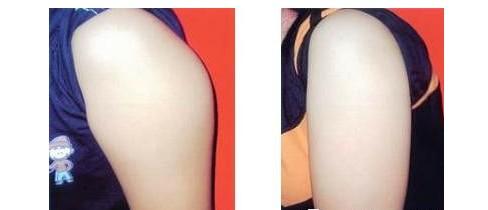 福州格萊美植發(fā)治療良效如何？黃興勇醫(yī)生發(fā)際線安全種植真的有效嗎？