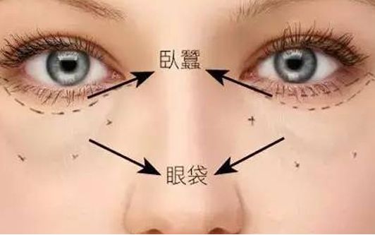 ?？谀募裔t(yī)院做眼袋效果好？