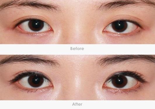 深圳哪家專業(yè)去黑眼圈機構(gòu)靠譜？