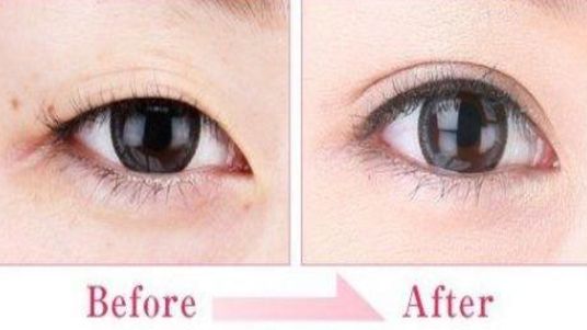 蘇州雙眼皮哪家做的好？專業(yè)攻略與醫(yī)師推薦