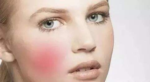 沈陽杏林醫(yī)生張瑩瑩治療雙眼皮修復(fù)效果如何？附真實(shí)網(wǎng)友高清修復(fù)前后對比圖