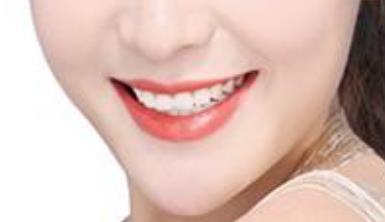 2023廈門電動負(fù)壓吸脂去雙下巴專家前10榜單(袁靜明、周璟、張俠網(wǎng)友親測好評名單分享！)