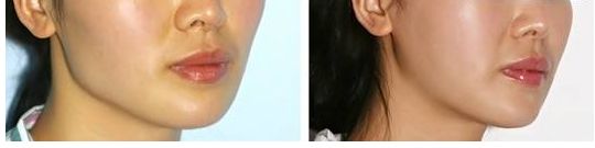 合肥假體隆胸哪家醫(yī)院好？術(shù)后效果如何？