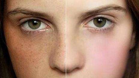 2023中山紅藍(lán)光照痤瘡權(quán)威醫(yī)生排行榜前10強(陳藝、許揚濱、楊佩英效果一絕，速看不虧！)