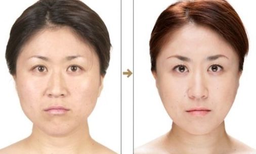 杭州整形醫(yī)院的抽脂效果如何？哪家醫(yī)院抽脂好？