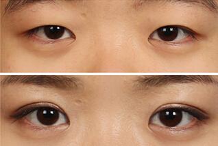 2023南京微創(chuàng)眼睛細(xì)紋手術(shù)醫(yī)生前10位排名(王軍成、江賀、郭鋒等都是強(qiáng)中強(qiáng))