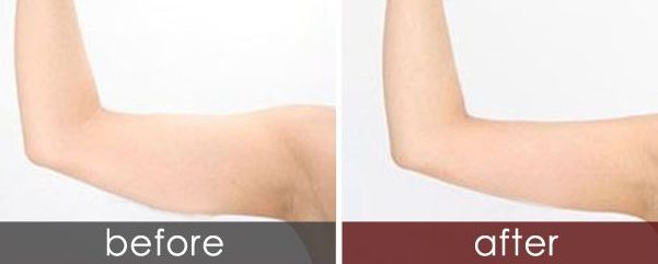 長春狐臭手術(shù)哪家醫(yī)院最專業(yè)？選擇哪家醫(yī)院治療狐臭效果好