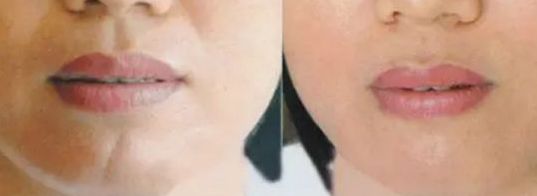 上海面部除疤效果最好的醫(yī)院有哪些？