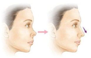 長沙美萊潘衛(wèi)峰做脂肪填充效果如何？醫(yī)生經(jīng)驗口碑詳細(xì)了解！