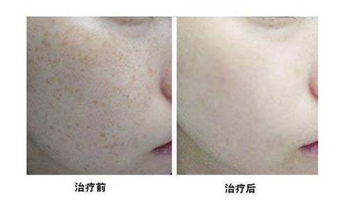 2023邯鄲治療太田痣醫(yī)生榜單前十名(宋蕾、許川、張丙?？靵砜纯催@些專家吧！)