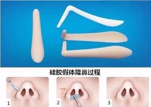 北京哪家醫(yī)院祛除眼袋效果最好？