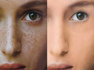 2023北京光子去雀斑排行榜前10名的醫(yī)生(武崇高、王凱瀠、邢志花在榜內(nèi))