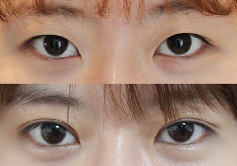 2023廣安微針祛除眼角紋醫(yī)生排行十強(qiáng)(陳雷、王靜、陳澤榕技術(shù)好收費(fèi)不坑)