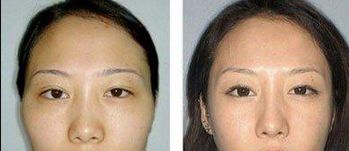 重慶去眼袋哪家醫(yī)院好？選擇靠譜的醫(yī)療機(jī)構(gòu)，功效更可靠！