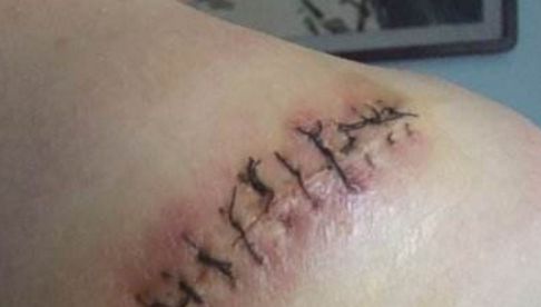 信陽哪家醫(yī)院祛痘效果好，專家推薦去哪家醫(yī)院治療痘痘？