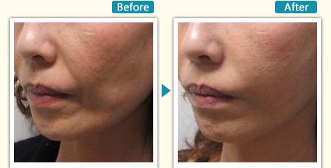 杭州哪家瘦腿針醫(yī)院好？全面解析杭州最受用戶歡迎的瘦腿針醫(yī)院推薦