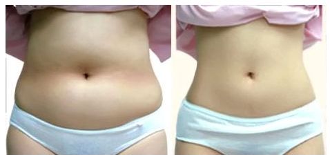 揭開上海韓式雙眼皮最佳選擇之謎