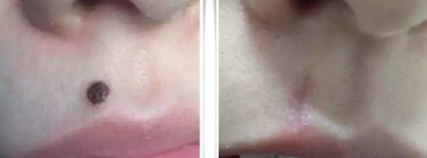 福州割眼袋醫(yī)院排行榜2023：哪家醫(yī)院割眼袋好？