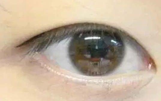 揭曉2023年武漢哪家醫(yī)院割雙眼皮好，專家推薦及真實(shí)案例！