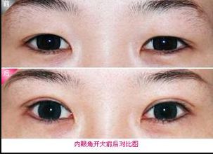 廊坊地區(qū)瘦臉針醫(yī)院排行榜2023：哪家醫(yī)院的瘦臉針效果好？