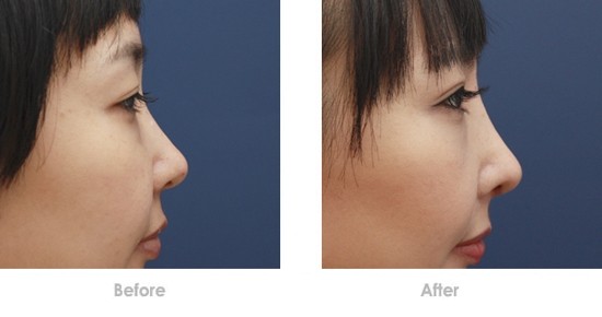 2023寧波激光去咖啡斑膨體隆鼻醫(yī)生前10強(qiáng)排名(鄔薇薇、高文彬、郭光燁經(jīng)驗(yàn)豐富不？)