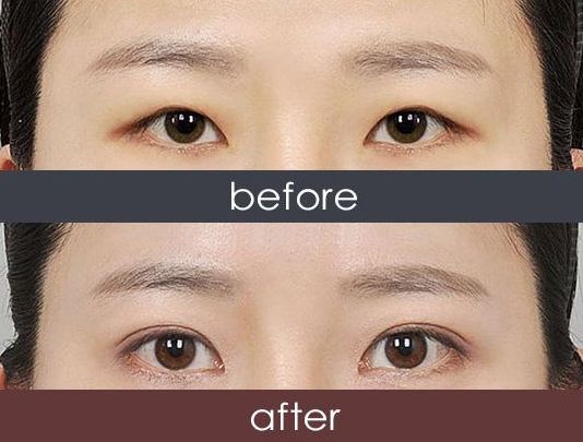 福州哪家醫(yī)院激光祛雀斑效果好？