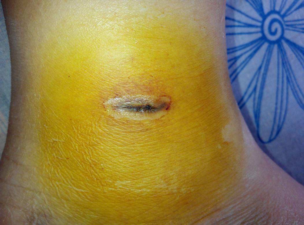 2023杭州激光去除青春痘專家前10名口碑排名(周長兵、許文澍、黃慶武口碑價格大PK)