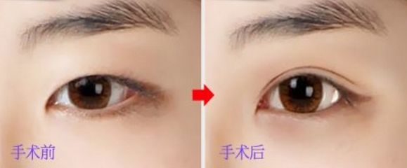 上海玻尿酸豐唇哪家醫(yī)院好？挑選上?？诒玫牟Ｄ蛩嶝S唇醫(yī)院