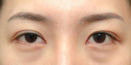 昆明做雙眼皮手術(shù)好的醫(yī)院有哪些？