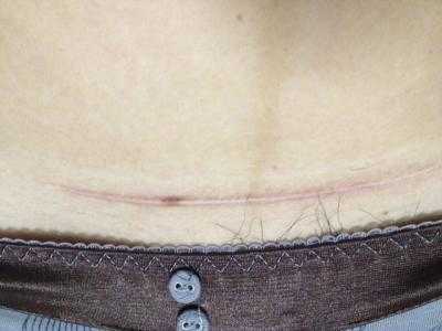 2023內(nèi)蒙古吸脂瘦身腹權(quán)威專家上榜前幾(李曉梅、劉露、韓楓技術(shù)、審美、口碑通通有)