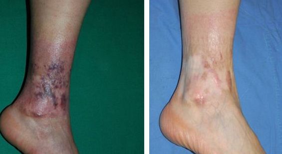 上海手術(shù)點痣醫(yī)院哪家好？揭秘上海最受歡迎的點痣醫(yī)院