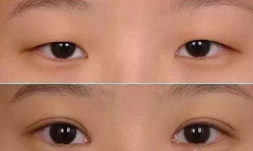 2023武漢玻尿酸注射隆鼻梁專家前10名排名(汪國民、謝想兵、張召優(yōu)質(zhì)醫(yī)生選擇)