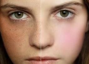 宿州疤痕修復醫(yī)院哪家好？幫你選擇最適合的宿州疤痕治療?？漆t(yī)院