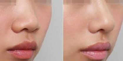 深圳修復(fù)雙眼皮哪家醫(yī)院好？淺談深圳雙眼皮修復(fù)專家排行榜